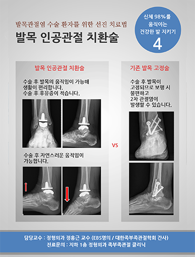 발목 인공관절 치환술
